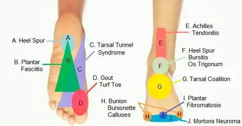 "Sole Search: Navigating Foot Pain with Foot Pain Charts"